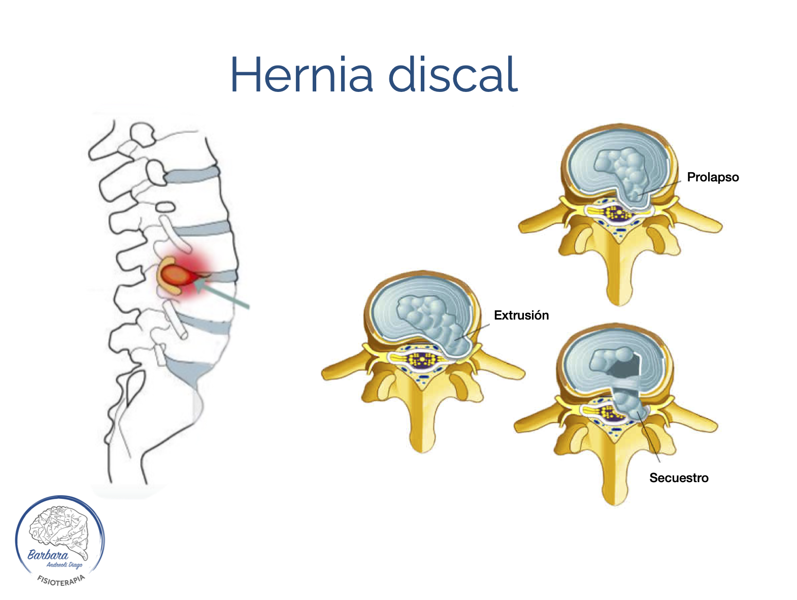 hernia discal