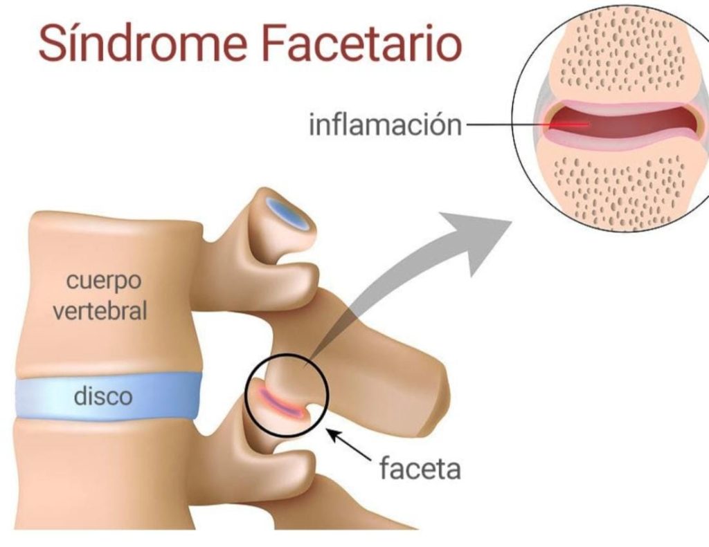 sindrome facetario