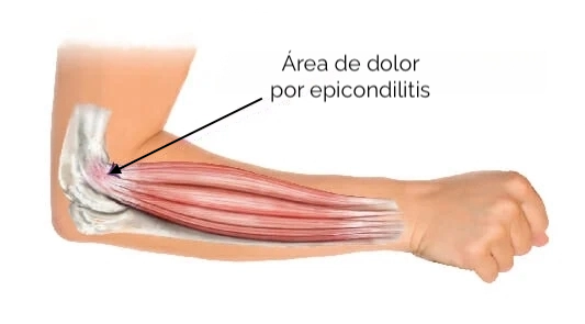 dolor por epicondilitis